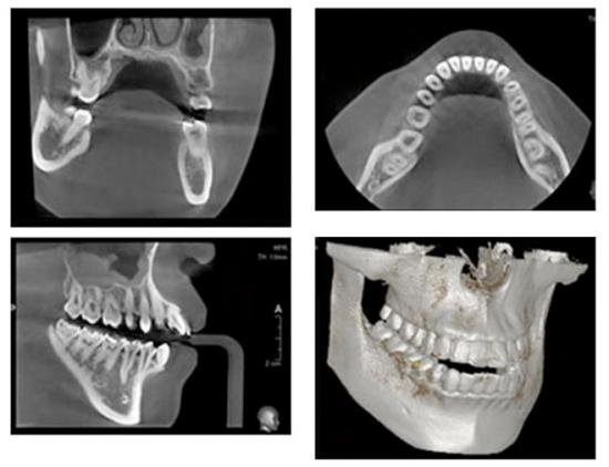 インプラント治療とCT検査