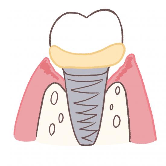 インプラント治療後の寿命・より長くインプラントを使用するには