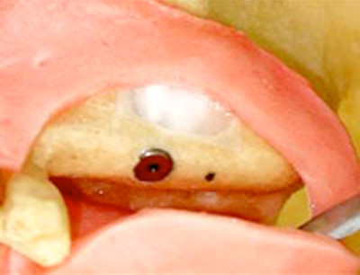 開けた穴を特殊な膜で塞ぎ、歯肉を縫合します